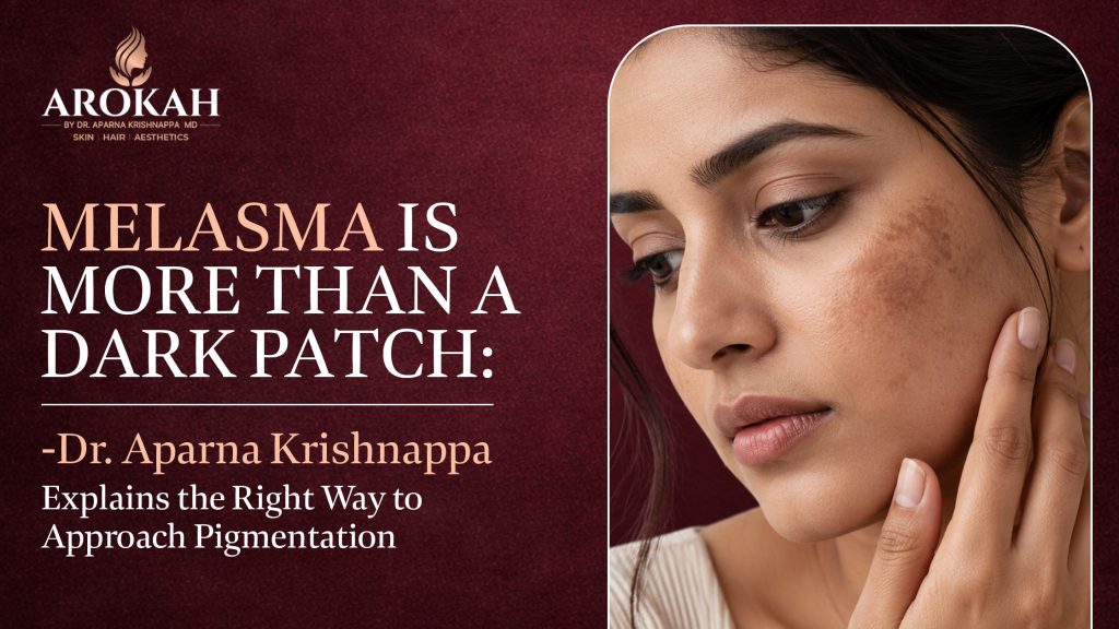 Melasma Treatment in Banjara Hills