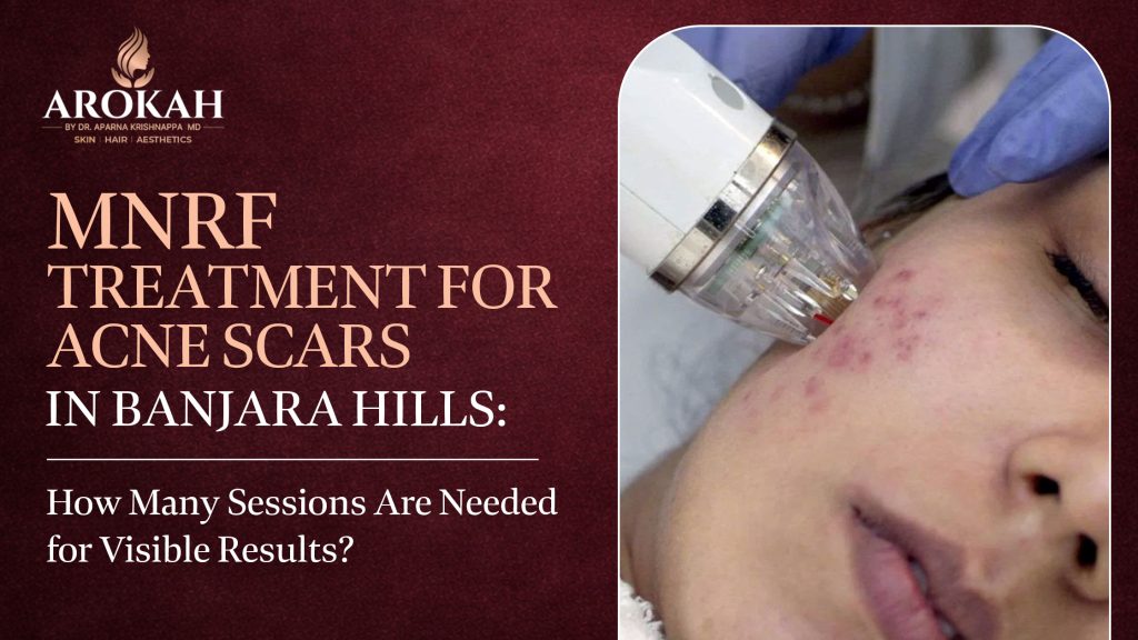 MNRF Treatment for Acne Scars